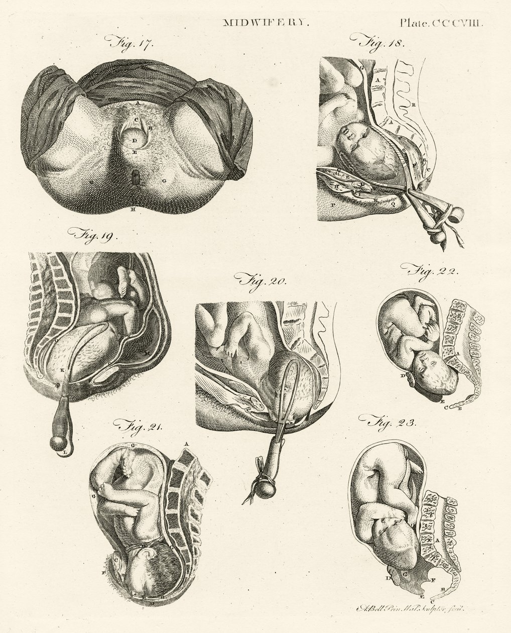 Geburtshilfe, Illustration aus 