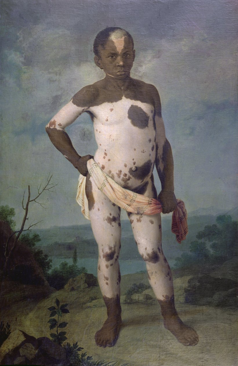 Kind mit Vitiligo, 1786 von Brazilian School