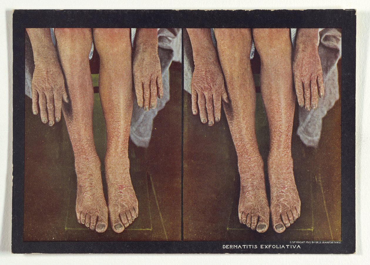 Dermatitis Exfoliativa von Dr. Selden I. Rainforth