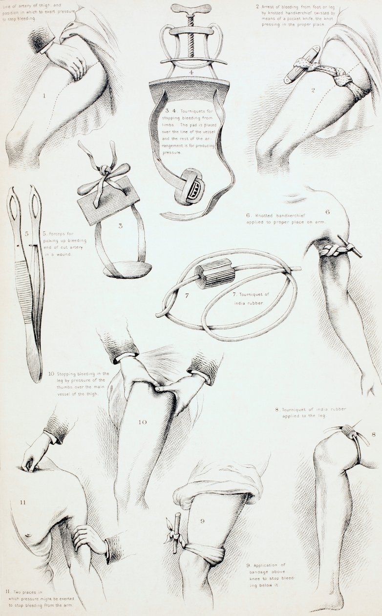 Methoden zur Blutstillung, um 1890 von English School
