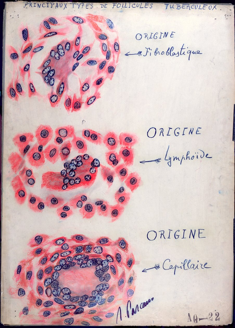Prinzipielle Tuberkulose-Follikel von French School
