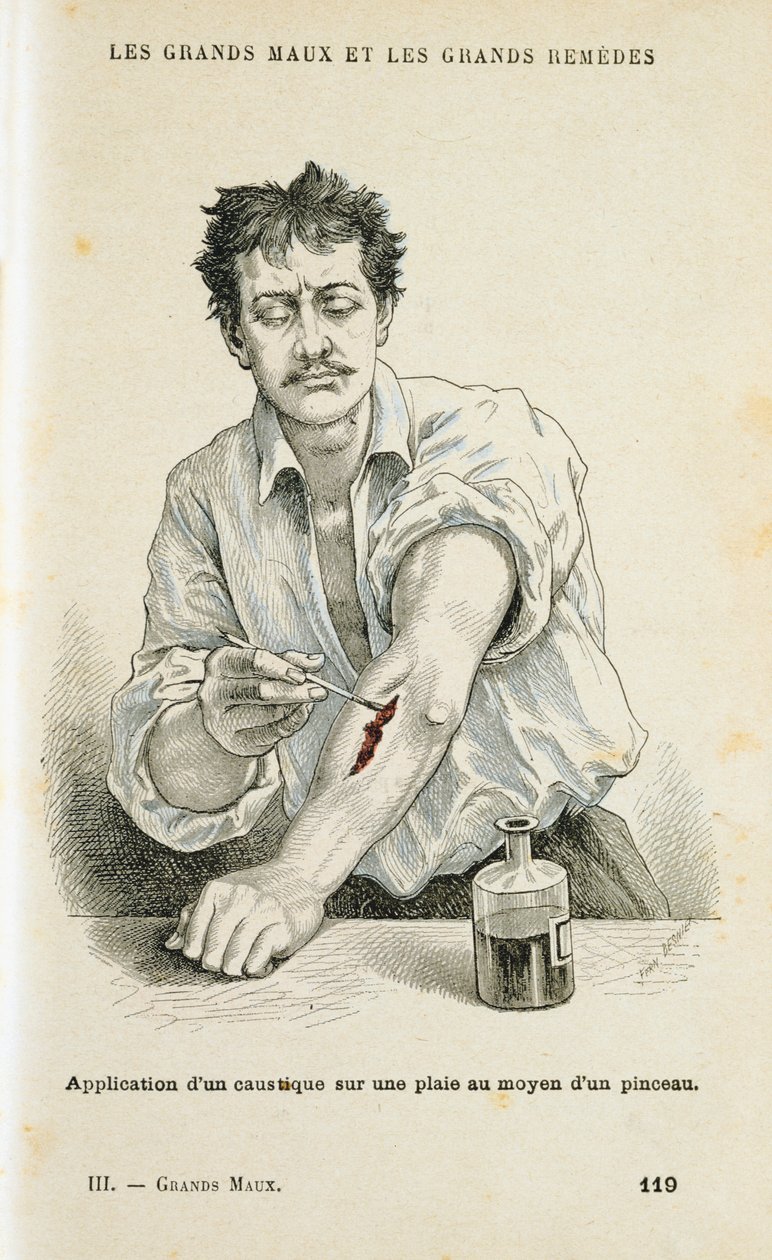 Eine Wunde mit einer antiseptischen Lösung behandeln, um 1890 von Unbekannt