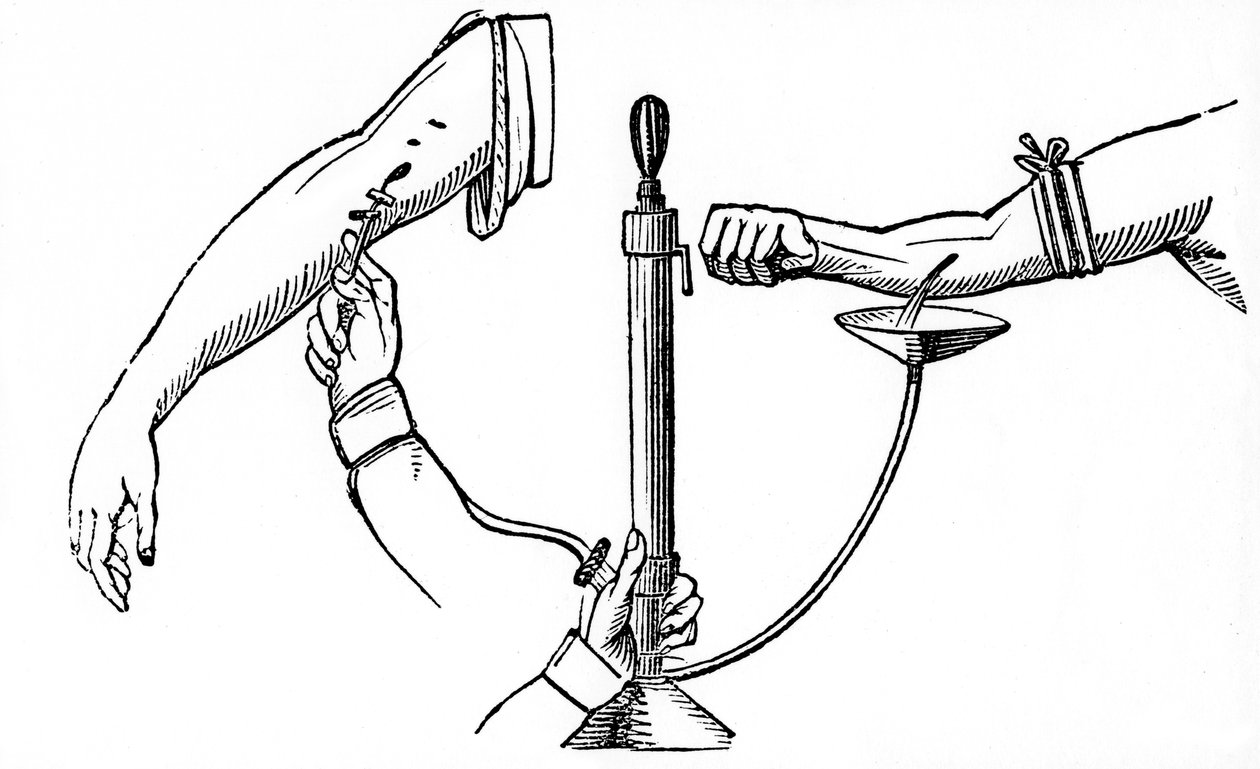 Person-zu-Person-Bluttransfusion, 1833 von Unbekannt