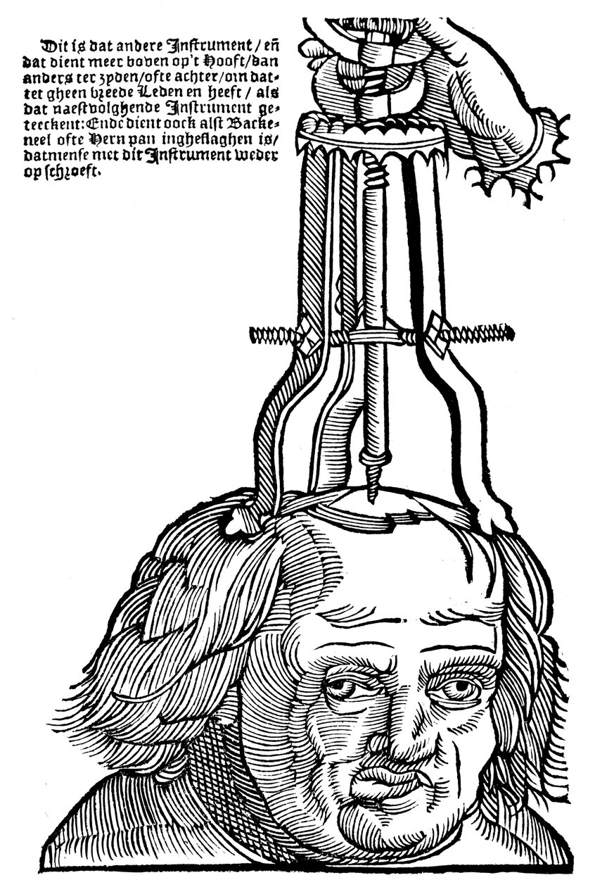 Trepanation, 1593 von Unbekannt