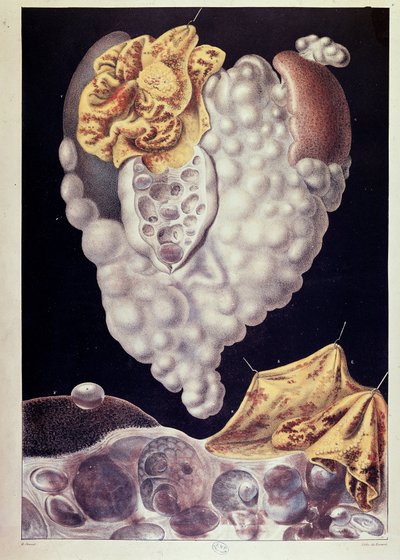 Krebs - von Cruveilhier von Jean Cruveilhier