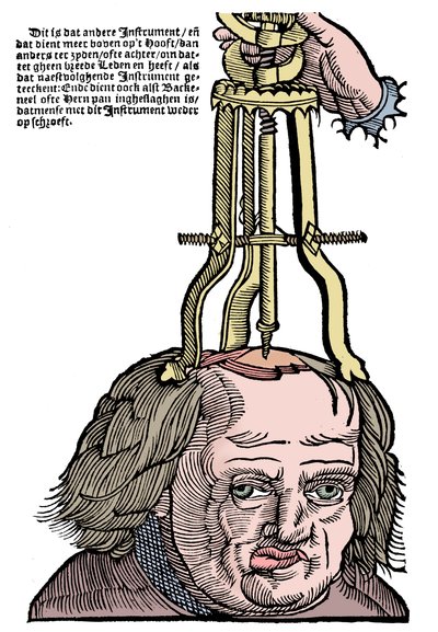 Trepanation von Unbekannt