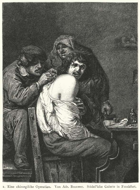Die Rückenoperation von Adriaen (after) Brouwer
