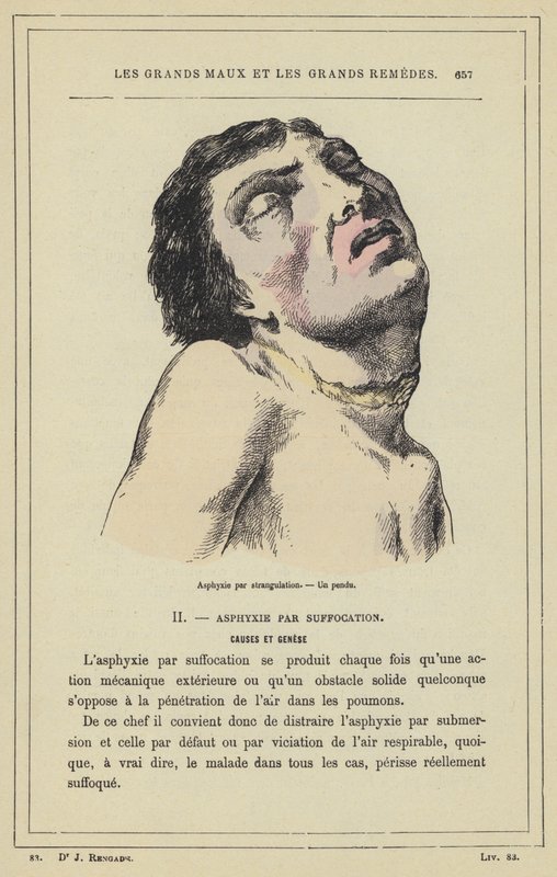 Erstickung durch Strangulation, Ein Gehängter von French School