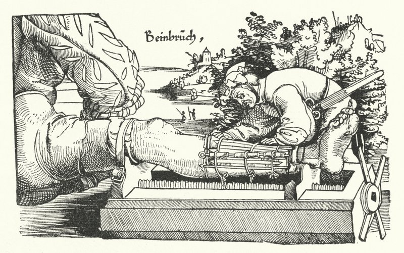 Behandlung eines gebrochenen Beins von German School